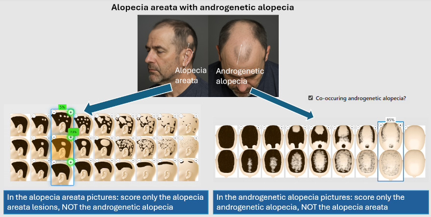 Androgenetic alopecia help